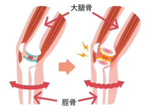 変形性膝関節症の画像